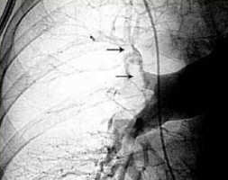 Тромбоэмболия легочной артерии (ТЭЛА) фото 4