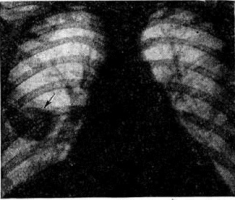 Тромбоэмболия легочной артерии (ТЭЛА) фото 2