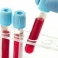 Анализ на общую железосвязывающую способность сыворотки крови (ОЖСС)