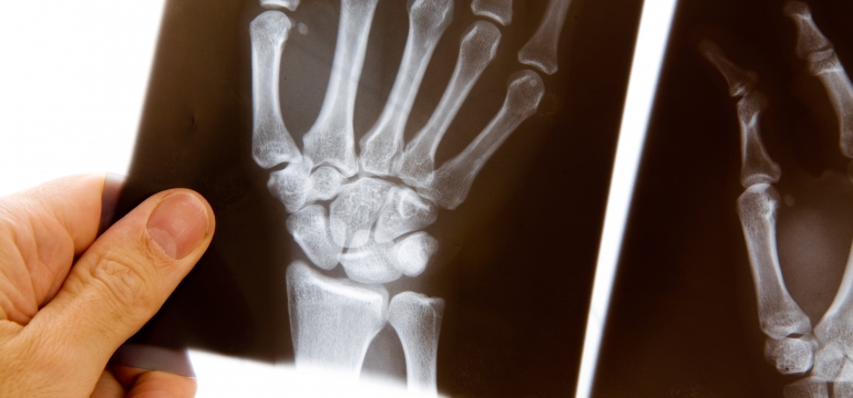 Рентген пальца на руке
