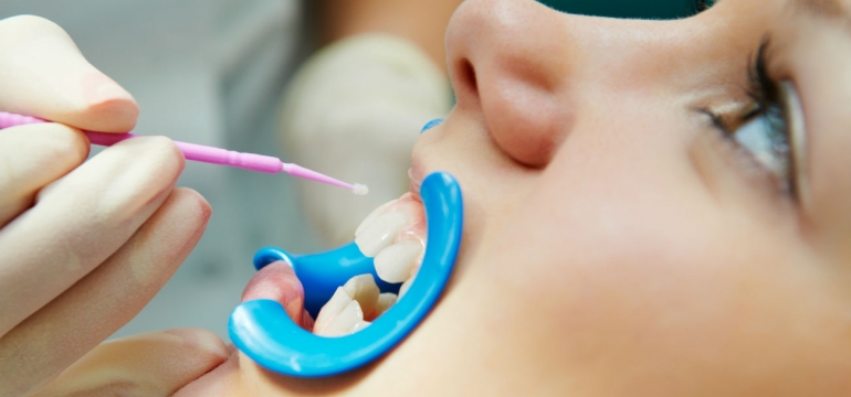 Процесс проведения реминерализации зубов