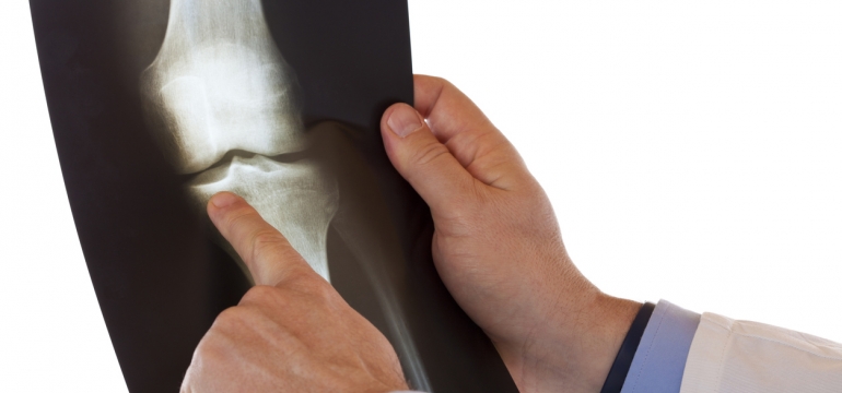 Рентген коленного сустава: противопоказания