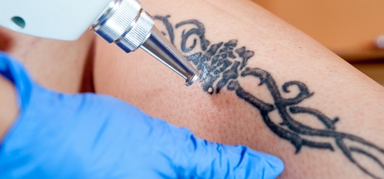 Процедура лазерного удаления татуировок